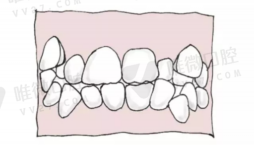 种植牙韩国奥齿泰怎么样（韩国种植牙和瑞士种植牙的区别）(图1)